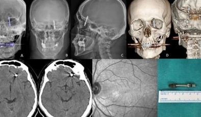 Bursa’da Diş Tedavisinde Kabus: Vida Hastanın Beynine Saplandı
