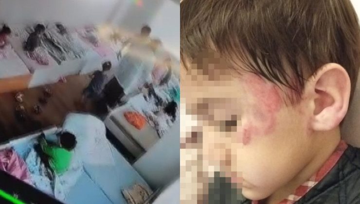 Anaokulunda Dehşet: 4 Yaşındaki Çocuk 3 Yaşındaki Çocuğu 13 Yerinden Isırdı! Doktorlar Aileye “Pitbull Mu Isırdı?” Diye Sordu?